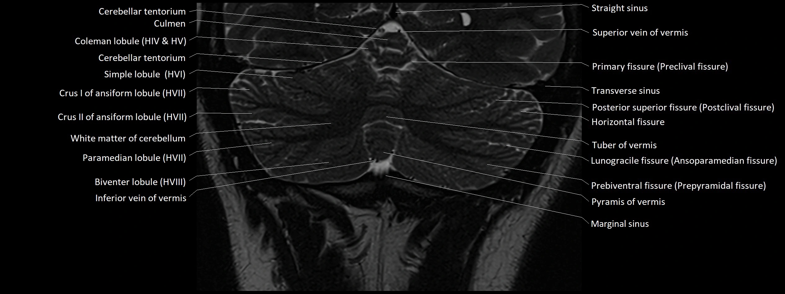 Anatomy of cerebellum coronal cross sectional 3T image 20.webp